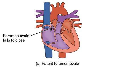 Foramen Ovale สิทธิบัตรคืออะไร? ตร foramen ovale